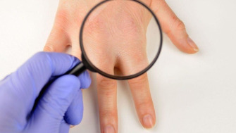 Care sunt diferențele dintre eczemă și psoriazis?