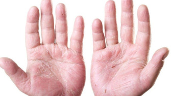 Eczema: cea mai frecventă boală a pielii