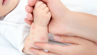 Eczema sugarului: boală benignă care nu trebuie neglijată