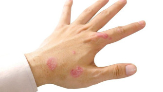Diferitele forme de psoriazis