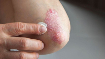 Psoriazisul: tratamente și soluții