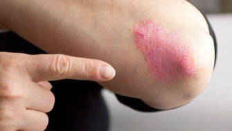 Psoriazisul: o boală cronică a pielii cu origini multiple