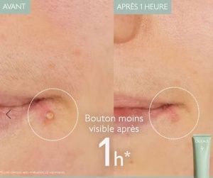 Caudalie Vinopure Cremă Împotriva Acneei Cu Acid Salicilic Tub 15ml - Img 2