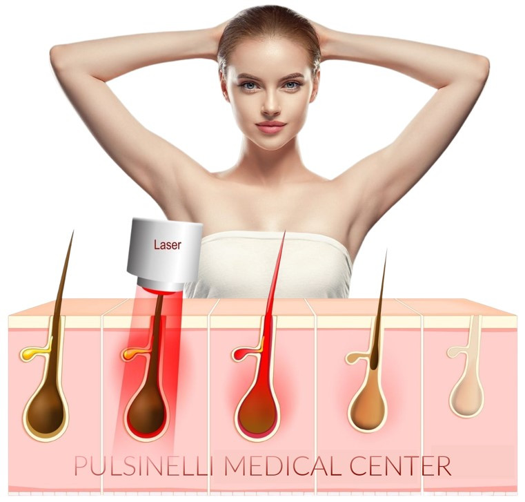 EPILAZIONE LASER ALESSANDRITE