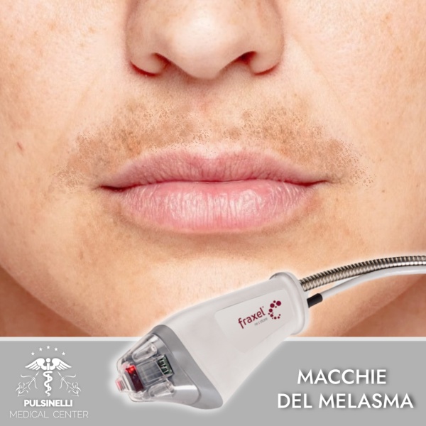 LASER FRAXEL MACCHIA SOPRA IL LABBRO