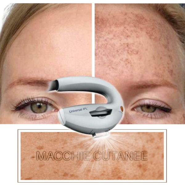 RIMOZIONE MACCHIE CUTANEE CON LASER M22 (IPL LUMENIS®)