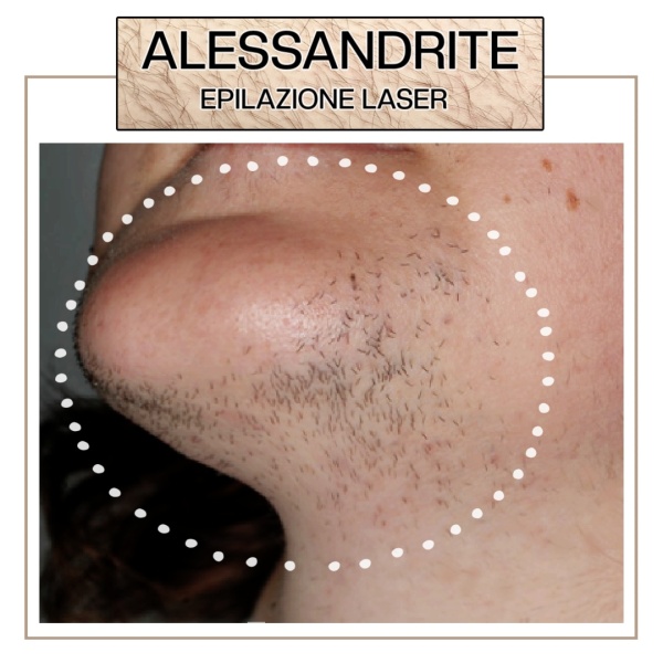 EPILAZIONE LASER ALESSANDRITE MENTO DIFFUSO