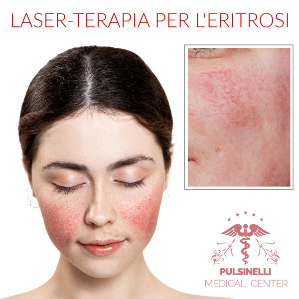 LASER-TERAPIA PER ERITROSI SUL VISO