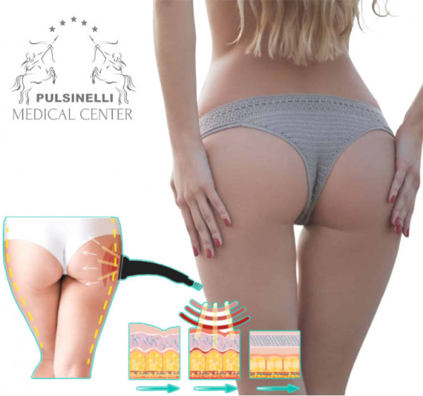RADIOFREQUENZA PER RIMODELLAMENTO E RINGIOVANIMENTO CUTANEO : GLUTEI