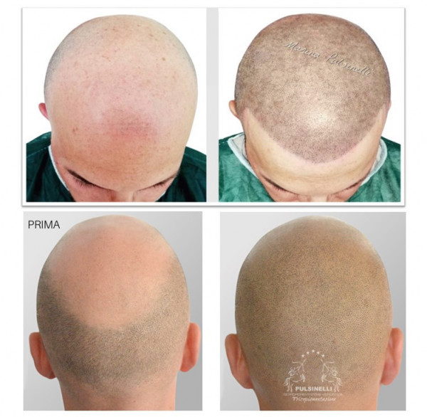 TRICOPIGMENTAZIONE PER ALOPECIA UNIVERSALE (SEDUTA DI TRE ORE)