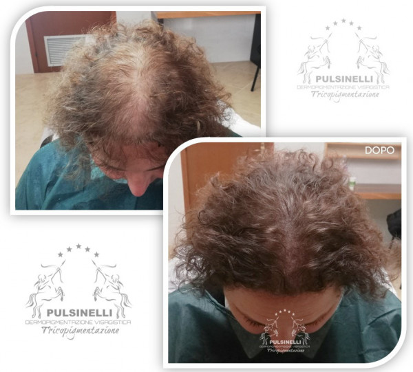 INFOLTIMENTO DEI CAPELLI CON TRICOPIGMENTAZIONE (SEDUTA DI 3 ORE)