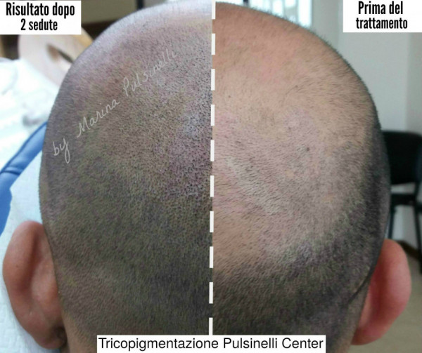 TRICOPIGMENTAZIONE PER ALOPECIA UNIVERSALE (SEDUTA DI 4 ORE)