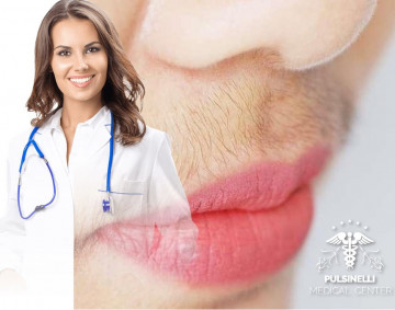 EPILAZIONE MEDICA LASER ALESSANDRITE : BAFFETTO 6 sedute