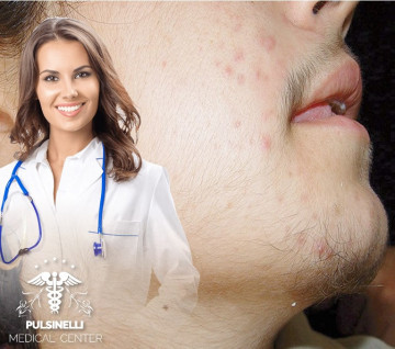 IRSUTISMOEPILAZIONE MEDICA LASER : VISO+ BAFFETTO + COLLO ANTERIORE 6 sedute