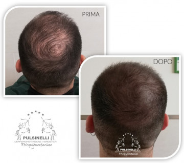 INFOLTIMENTO DEI CAPELLI CON TRICOPIGMENTAZIONE (seduta di 1h 30 min )