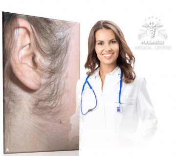 IRSUTISMO EPILAZIONE MEDICA LASER : LATI DEL VISO 12 sedute