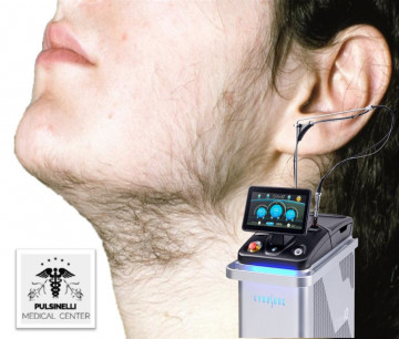 EPILAZIONE MEDICA LASER ALESSANDRITE : VISO+ BAFFETTO + COLLO ANTERIORE