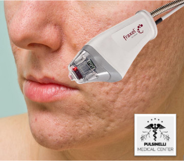 LASER FRAXEL TRATTAMENTO CICATRICI VISO PARZIALE