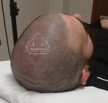 INFOLTIMENTO DEI CAPELLI CON TRICOPIGMENTAZIONE (SEDUTA DI 4 ORE)