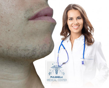 IRSUTISMO EPILAZIONE MEDICA LASER : MENTO DIFFUSO + BAFFETTO 12 sedute