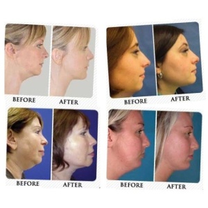Neckline Slimmer aparat za eliminisanje podbratka - Img 5