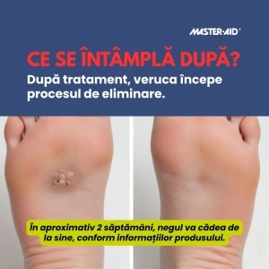 Verucă plantară înainte și după tratament cu Crio Spray Verruche