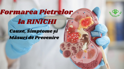 Formarea Pietrelor la Rinichi - Cauze, Simptome și Măsuri de Prevenire