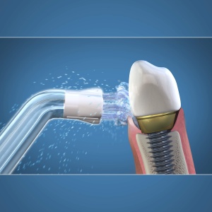 Accesorii Waterpik Plaque Seeker Accesorii de inlocuire pentru curatarea implanturilor dentare coroane si punti pachet de 2 PS-100E - Img 3