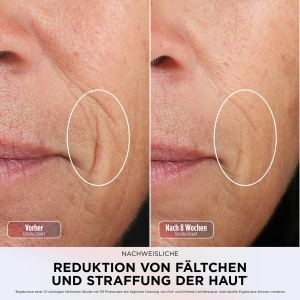 Masca LED pentru fata Shark CryoGlow, racire oculara, anti-aging, culoare mov - Img 9