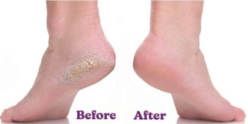 At Home Foot Care Combo - Footlogix - Img 2
