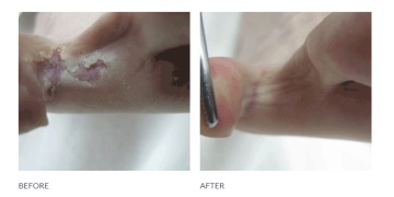 Peeling Skin Formula 125ml - Footlogix - Img 2