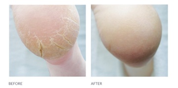 Cracked Heel Formula 125ml - Footlogix - Img 2