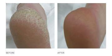 Rough Skin Formula 125ml - Footlogix - Img 2