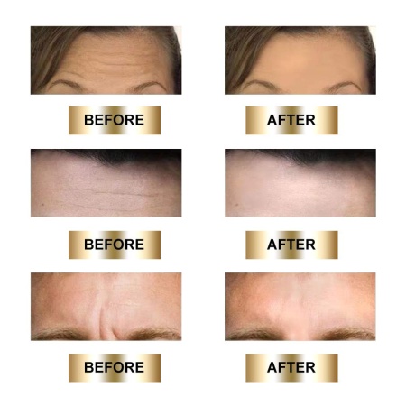 Masca antirid reutilizabila Antiaging REFINE pentru zona fruntii, Forehead Pad Anti Wrinkle, din silicon medical, antiinflamator si hidratant - Img 4