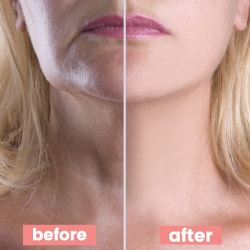 Masca antirid reutilizabila Antiaging REFINE pentru zona gatului, Neck Pad Anti Wrinkle, din silicon medical, antiinflamator si hidratant, transparent - Img 5