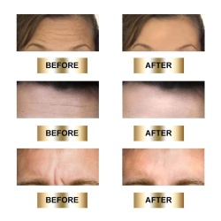 Masca antirid reutilizabila Antiaging REFINE pentru zona fruntii, Forehead Pad Anti Wrinkle, din silicon medical, antiinflamator si hidratant - Img 4