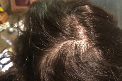 Alopecia difuza