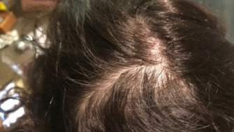 Alopecia difuza