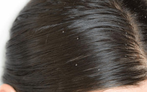 Matreata si eczema (dermatita) seboreica