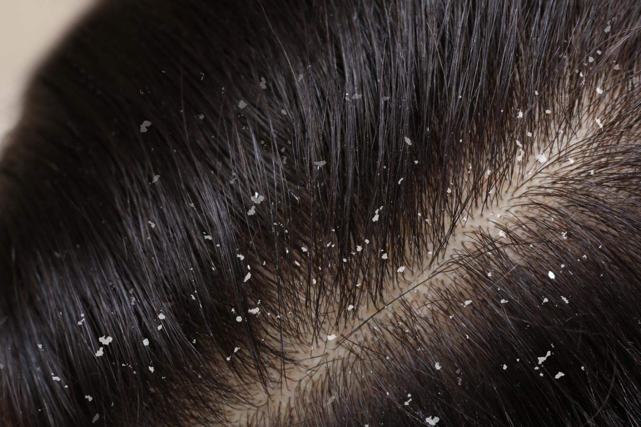 Scalp sensibil cauze - par saten, matreata