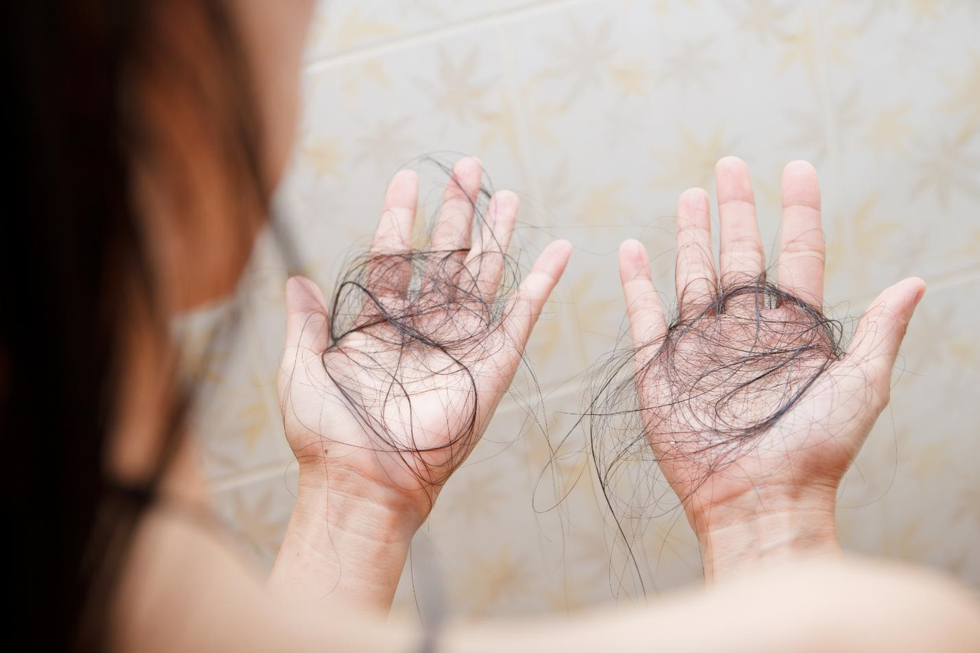 alopecia areata cauze, femeie, fire de par cazute