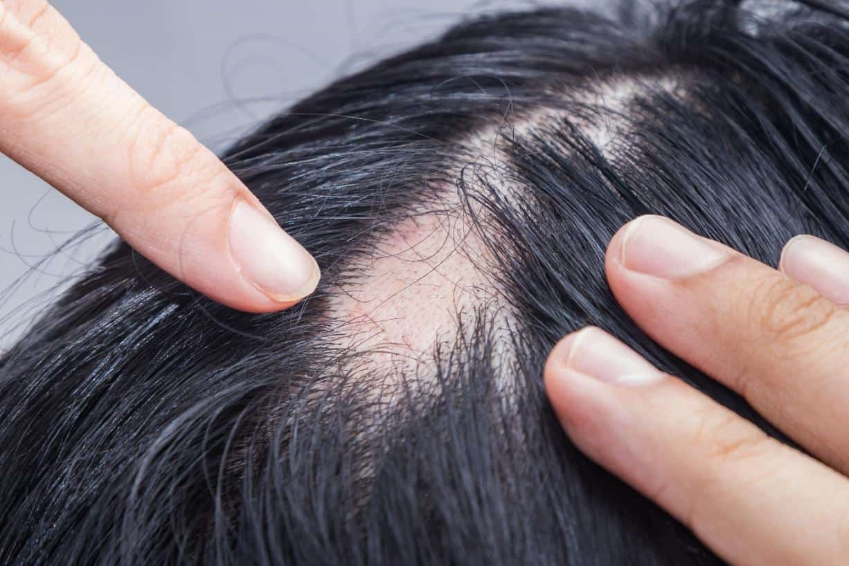 alopecie areata, par negru, maini