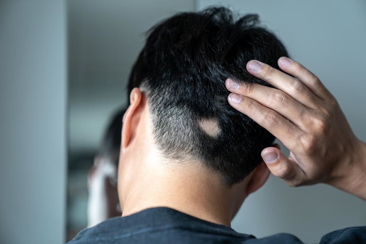 alopecia areata, bărbat