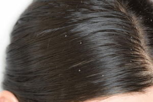 ANTIMATREATA, MANCARIME SCALP
