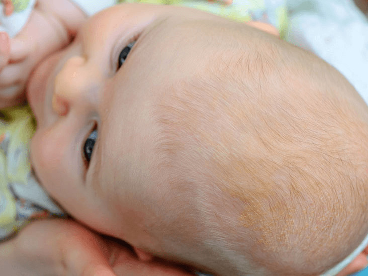 Cojite in cap la bebelusi: de ce apar si cum se trateaza?