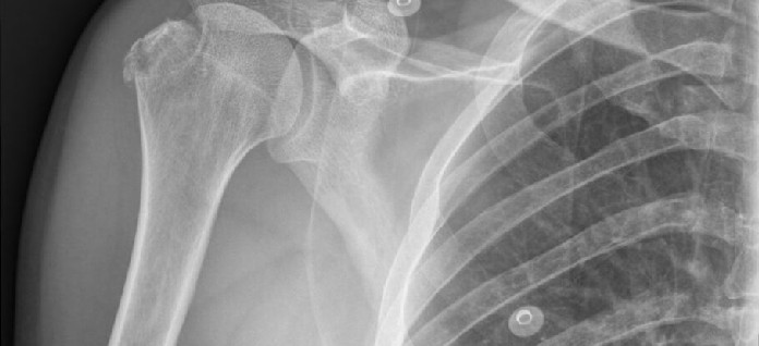 Fractura de Humerus Proximal, simptomatologie, recomandări, tratament și recuperare