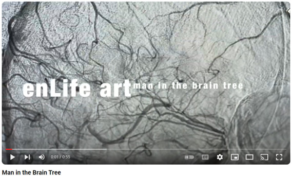 Stroke interpreted through the painting „The Man from the Brain Tree”