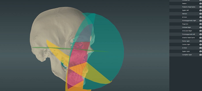 MICE, the Medical Implants AI-Driven 3D Customization Engine