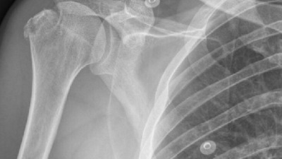 Fractura de Humerus Proximal, simptomatologie, recomandări, tratament și recuperare