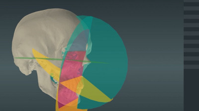 MICE, the Medical Implants AI-Driven 3D Customization Engine